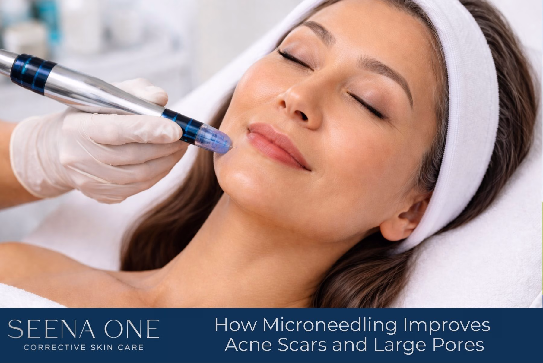 How Microneedling Improves Acne Scars and Large Pores